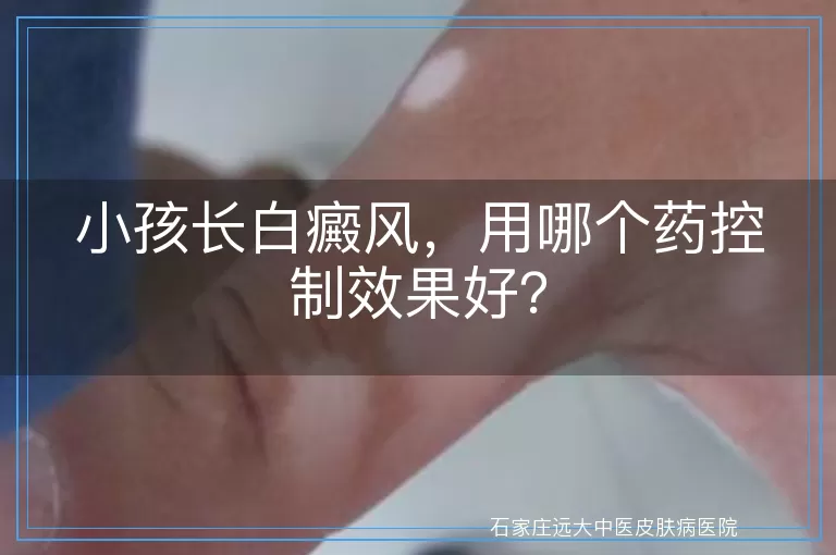 小孩长白癜风，用哪个药控制效果好？