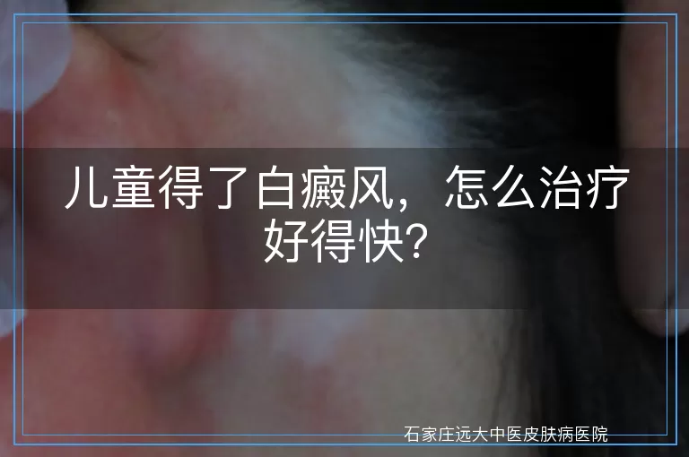 儿童得了白癜风，怎么治疗好得快？