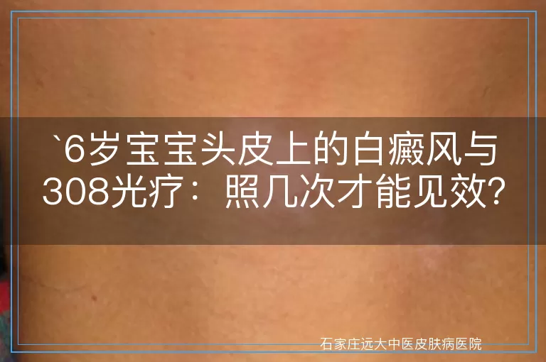 6岁宝宝头皮上的白癜风与308光疗：照几次才能见效？