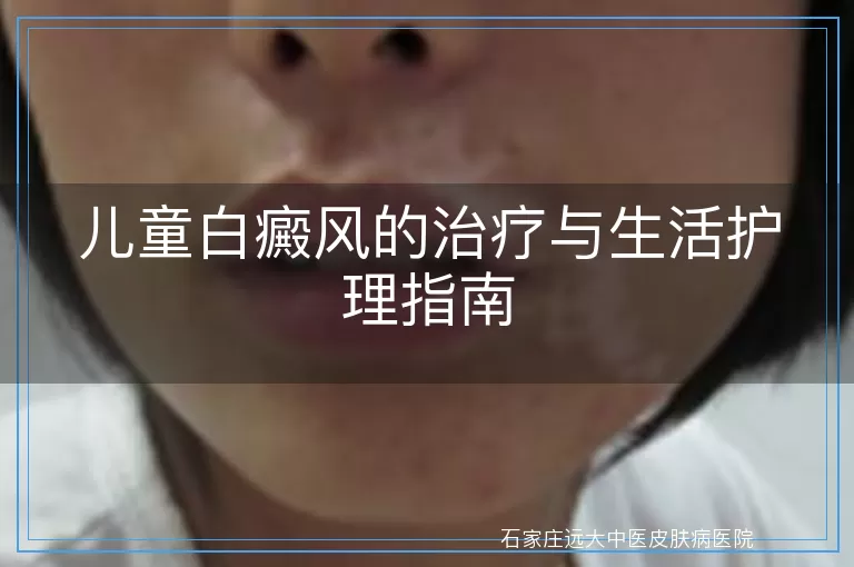 儿童白癜风的治疗与生活护理指南
