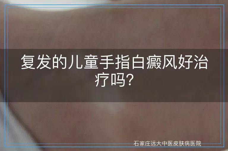 复发的儿童手指白癜风好治疗吗？