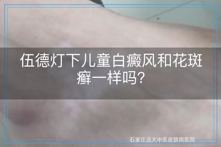 伍德灯下儿童白癜风和花斑癣一样吗？