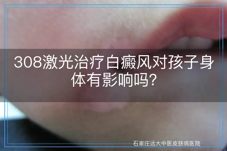308激光治疗白癜风对孩子身体有影响吗？