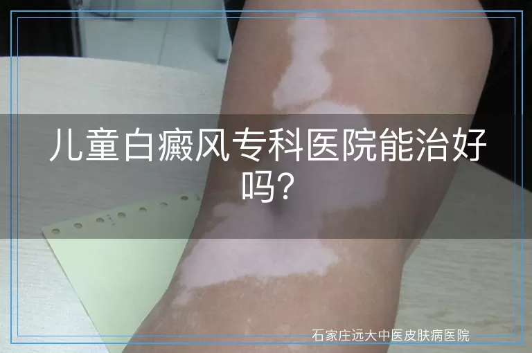 儿童白癜风专科医院能治好吗？