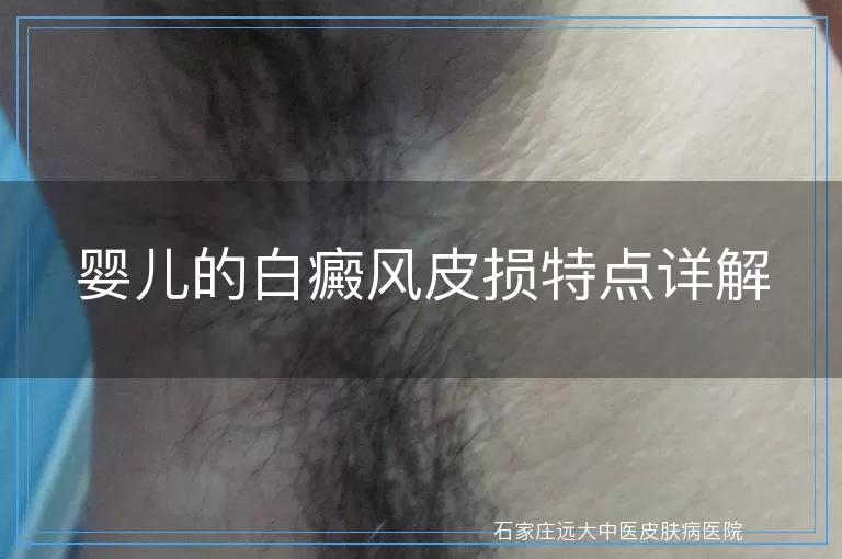 婴儿的白癜风皮损特点详解
