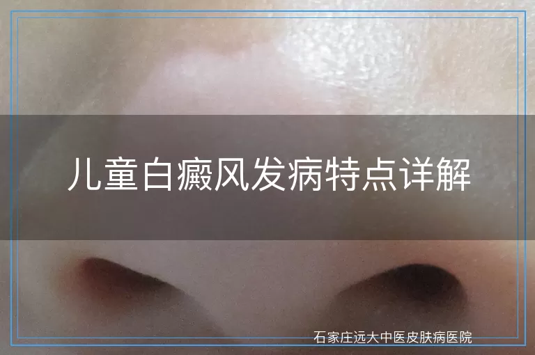 儿童白癜风发病特点详解