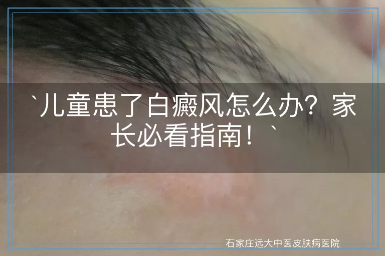 儿童患了白癜风怎么办？家长必看指南！