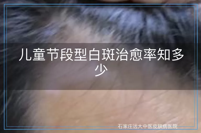儿童节段型白斑治愈率知多少