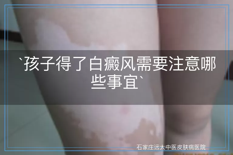 孩子得了白癜风需要注意哪些事宜