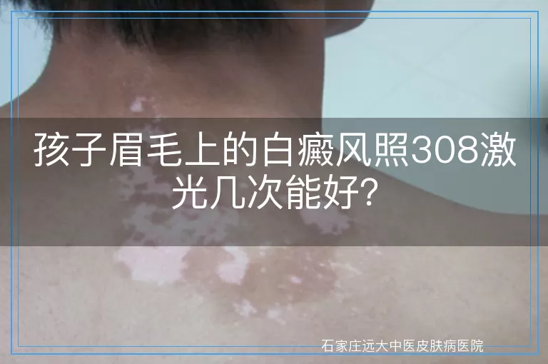 孩子眉毛上的白癜风照308激光几次能好？