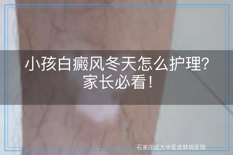 小孩白癜风冬天怎么护理？家长必看！