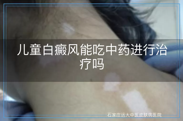 儿童白癜风能吃中药进行治疗吗