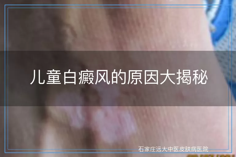 儿童白癜风的原因大揭秘