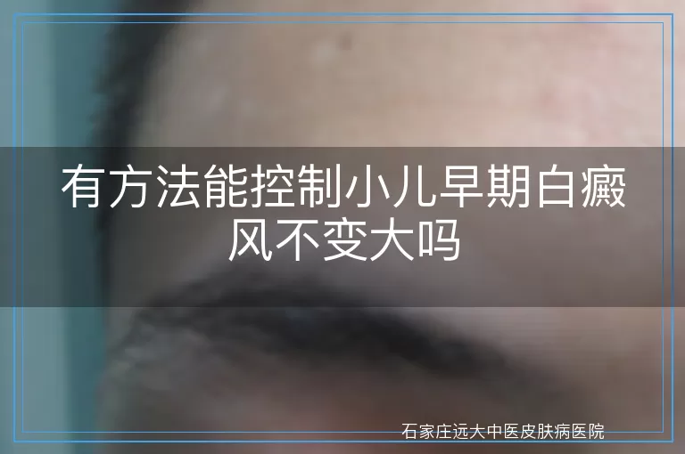有方法能控制小儿早期白癜风不变大吗