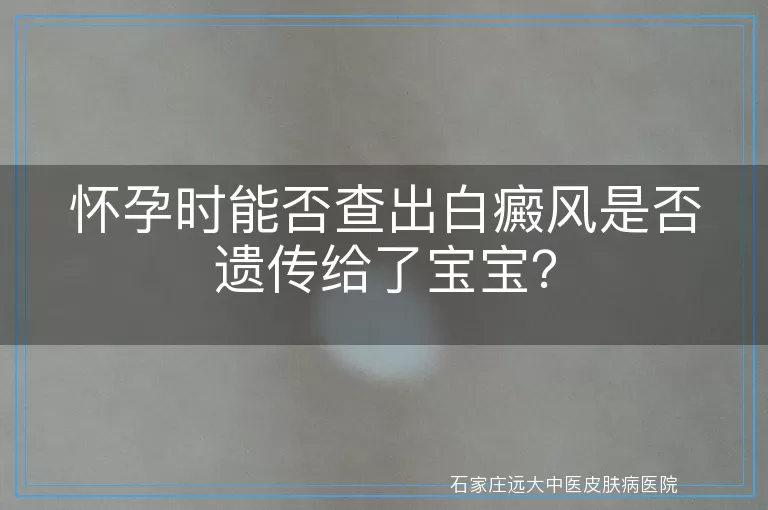 怀孕时能否查出白癜风是否遗传给了宝宝？