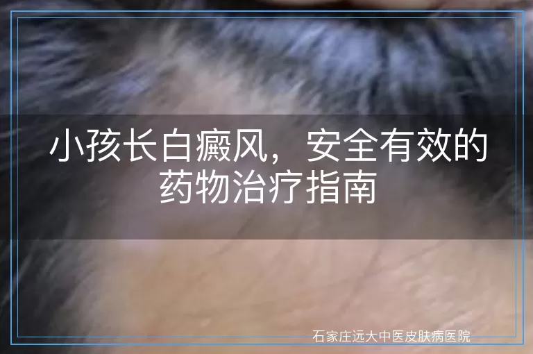 小孩长白癜风，安全有效的药物治疗指南