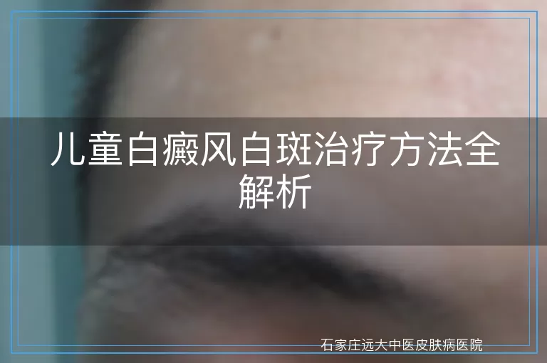 儿童白癜风白斑治疗方法全解析