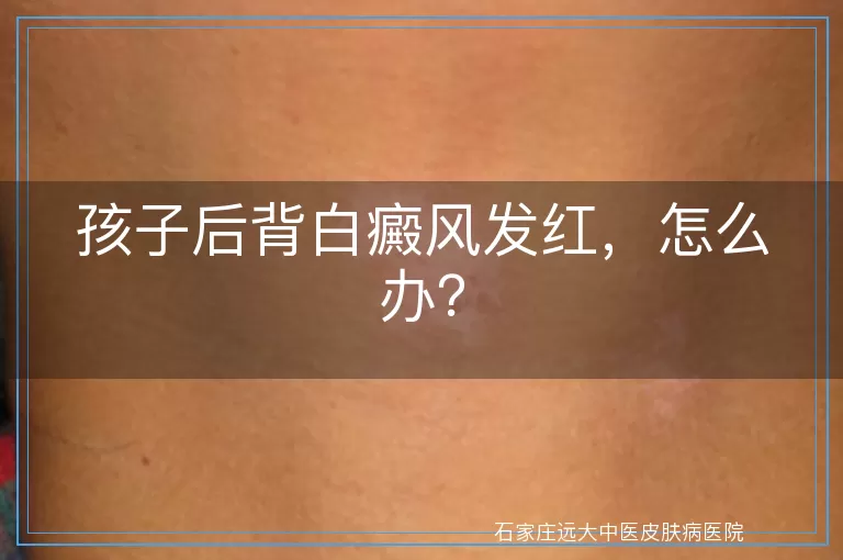 孩子后背白癜风发红，怎么办？