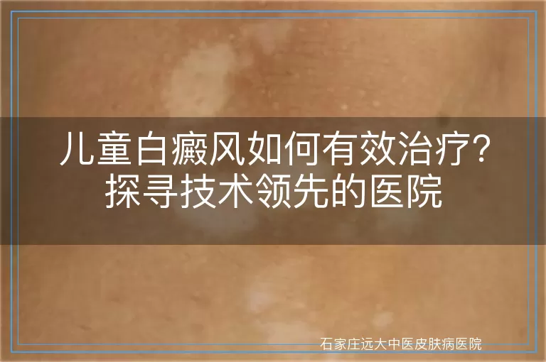 儿童白癜风如何有效治疗?探寻技术领先的医院
