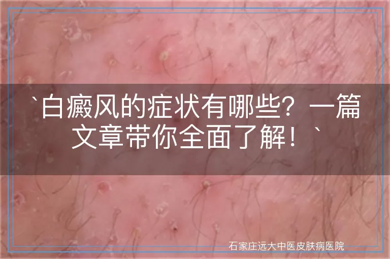 白癜风的症状有哪些？一篇文章带你全面了解！