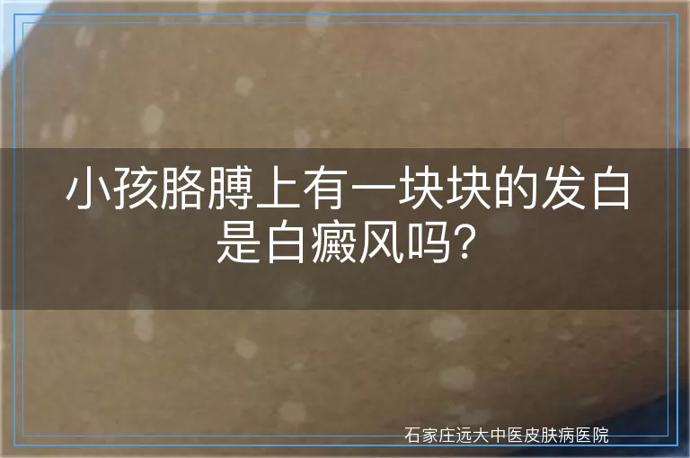 小孩胳膊上有一块块的发白是白癜风吗?