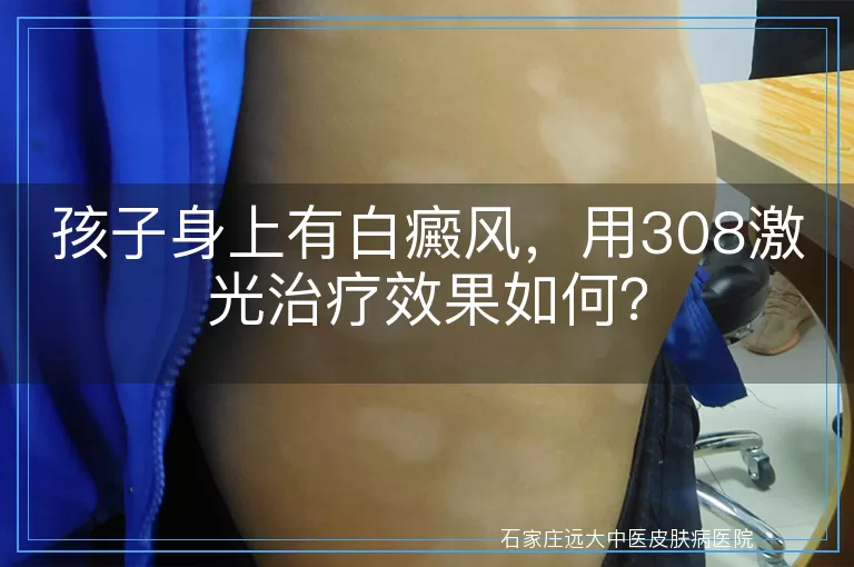 孩子身上有白癜风，用308激光治疗效果如何？