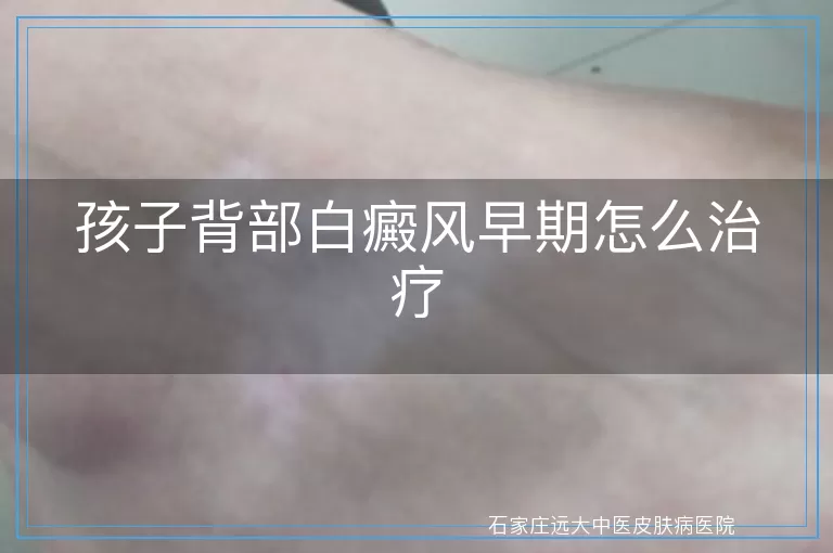 孩子背部白癜风早期怎么治疗