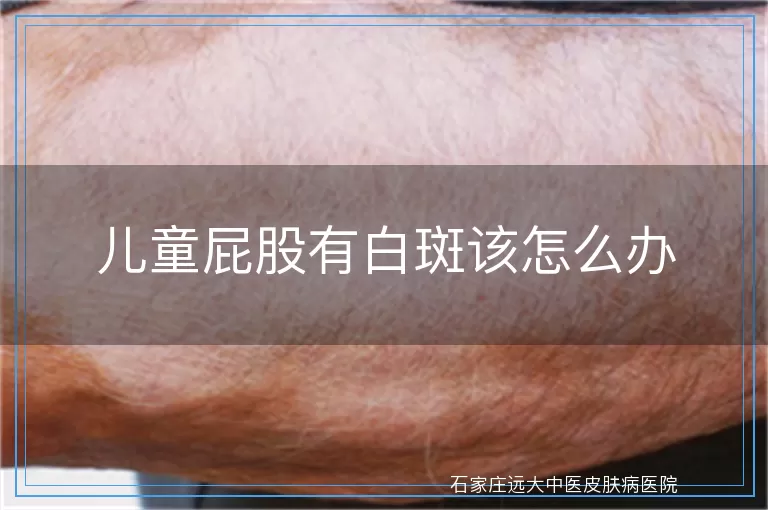 儿童屁股有白斑该怎么办