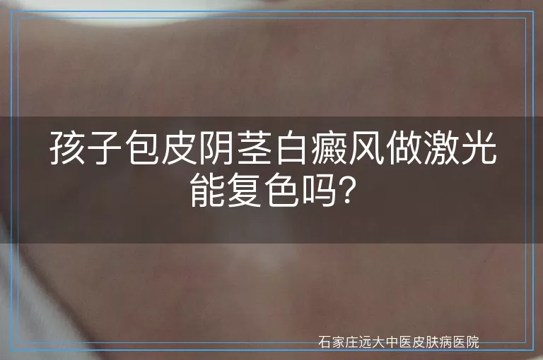 孩子包皮阴茎白癜风做激光能复色吗？