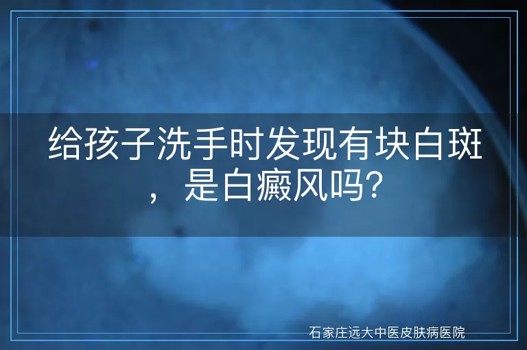 给孩子洗手时发现有块白斑，是白癜风吗？