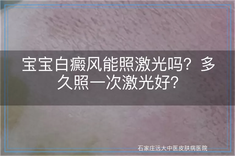 宝宝白癜风能照激光吗？多久照一次激光好？
