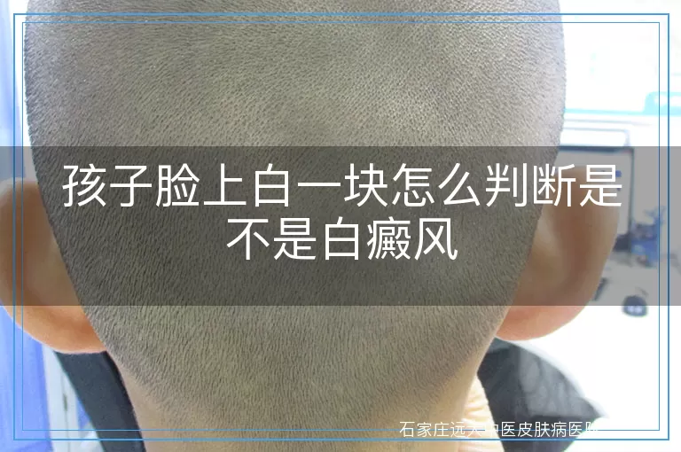 孩子脸上白一块怎么判断是不是白癜风