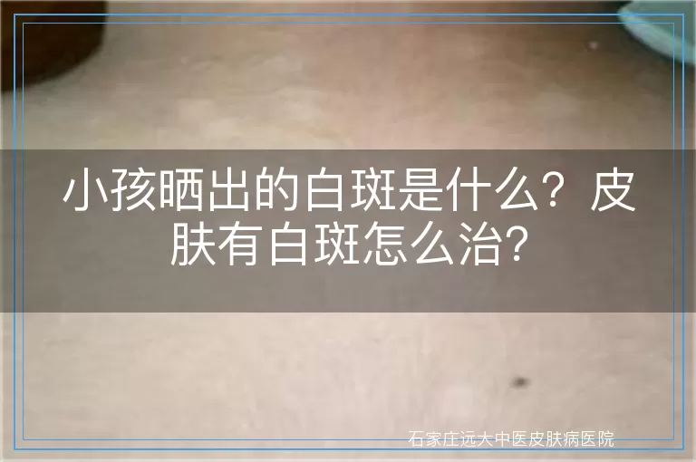 小孩晒出的白斑是什么？皮肤有白斑怎么治？