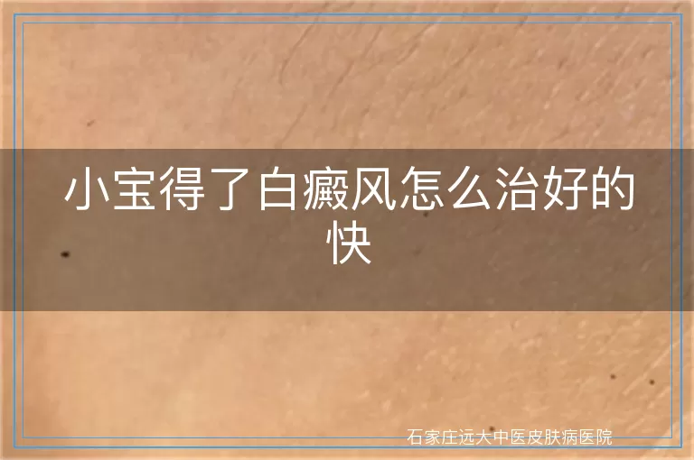 小宝得了白癜风怎么治好的快