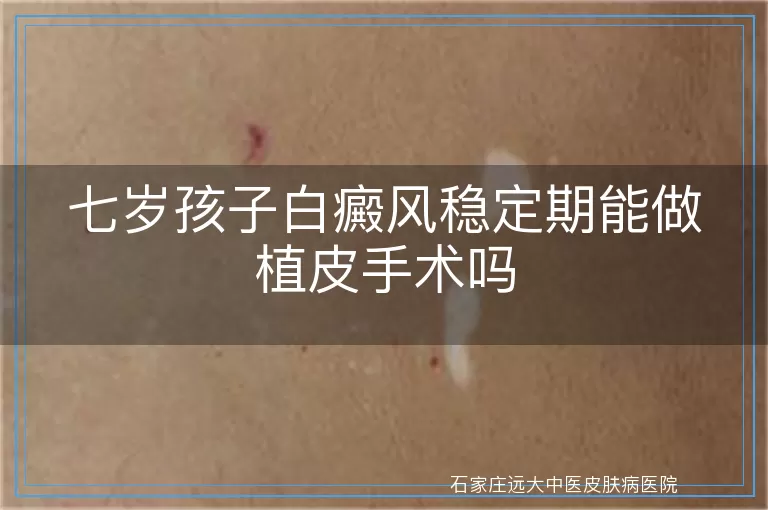 七岁孩子白癜风稳定期能做植皮手术吗