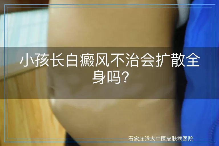 小孩长白癜风不治会扩散全身吗？