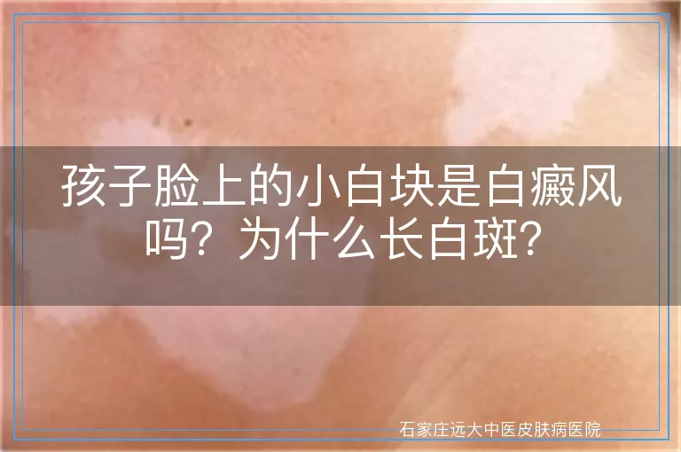 孩子脸上的小白块是白癜风吗?为什么长白斑?