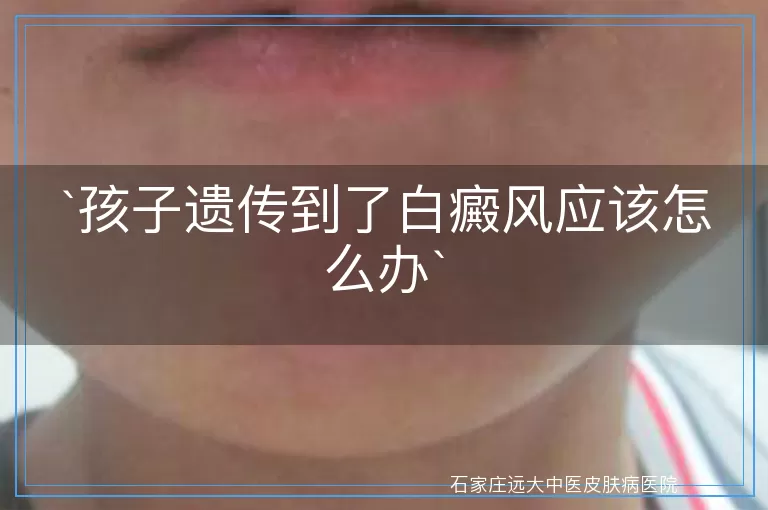 孩子遗传到了白癜风应该怎么办