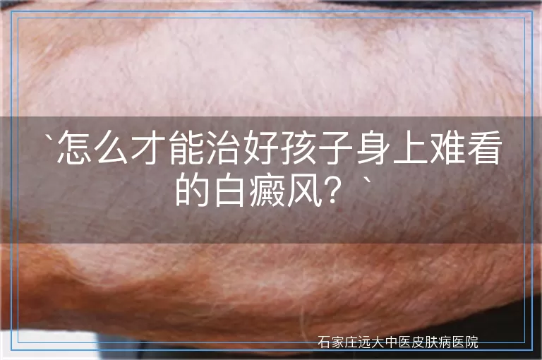 怎么才能治好孩子身上难看的白癜风？