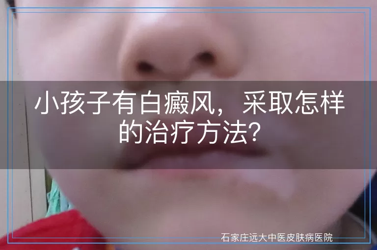 小孩子有白癜风，采取怎样的治疗方法？