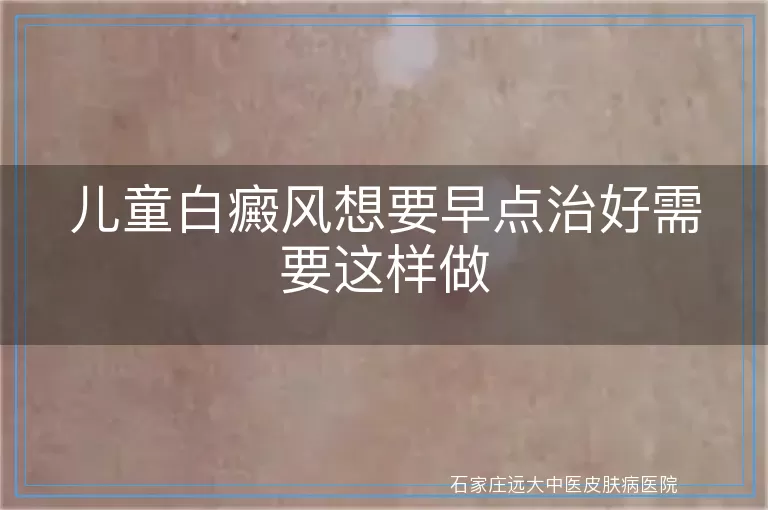 儿童白癜风想要早点治好需要这样做