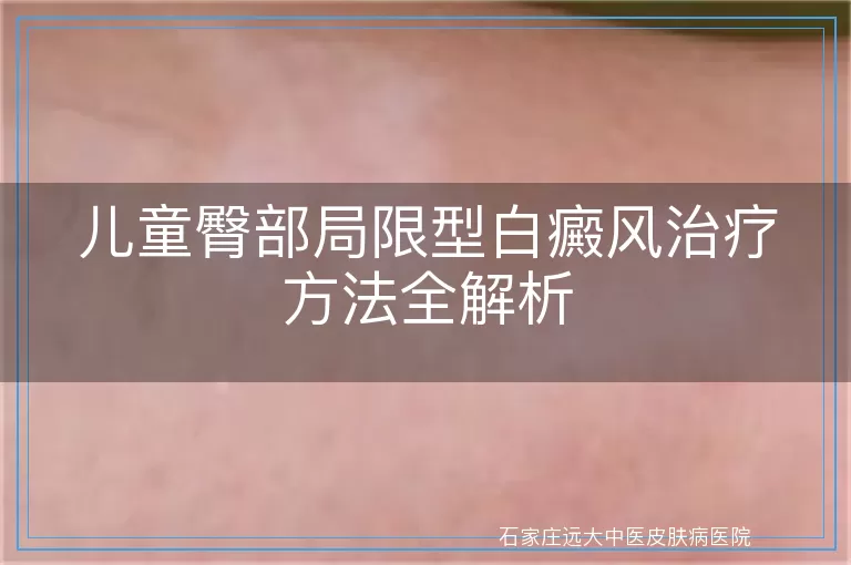 儿童臀部局限型白癜风治疗方法全解析
