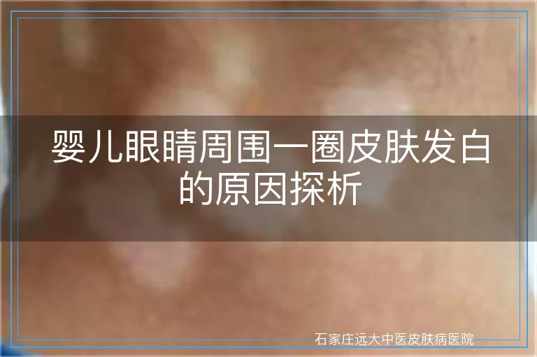婴儿眼睛周围一圈皮肤发白的原因探析
