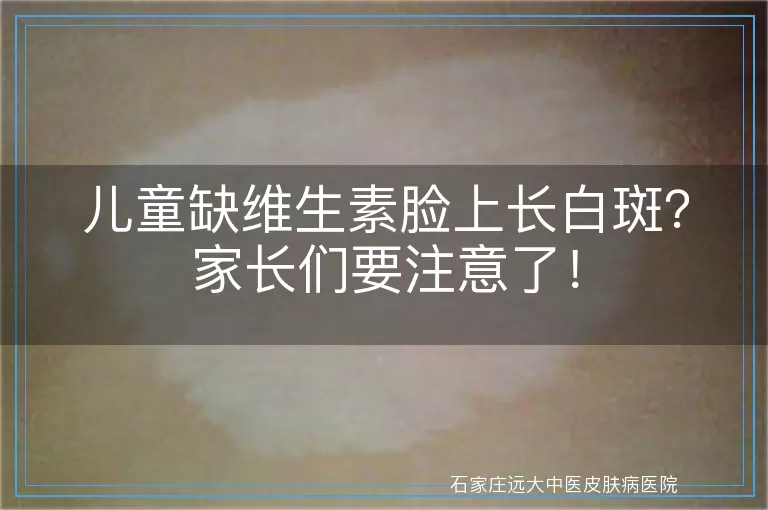 儿童缺维生素脸上长白斑？家长们要注意了！