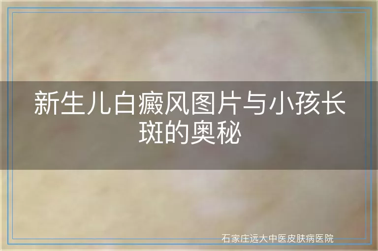 新生儿白癜风图片与小孩长斑的奥秘