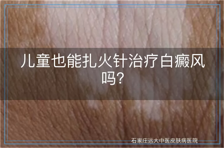 儿童也能扎火针治疗白癜风吗？