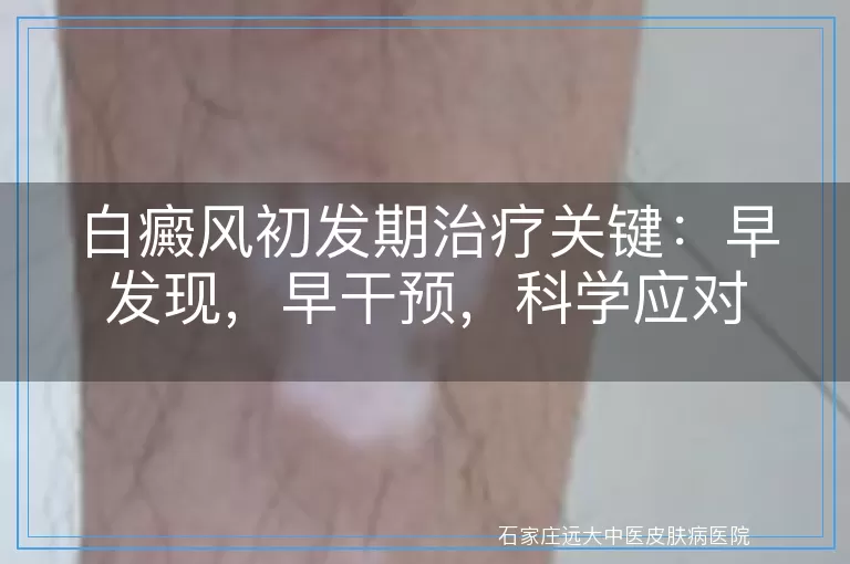 白癜风初发期治疗关键：早发现，早干预，科学应对