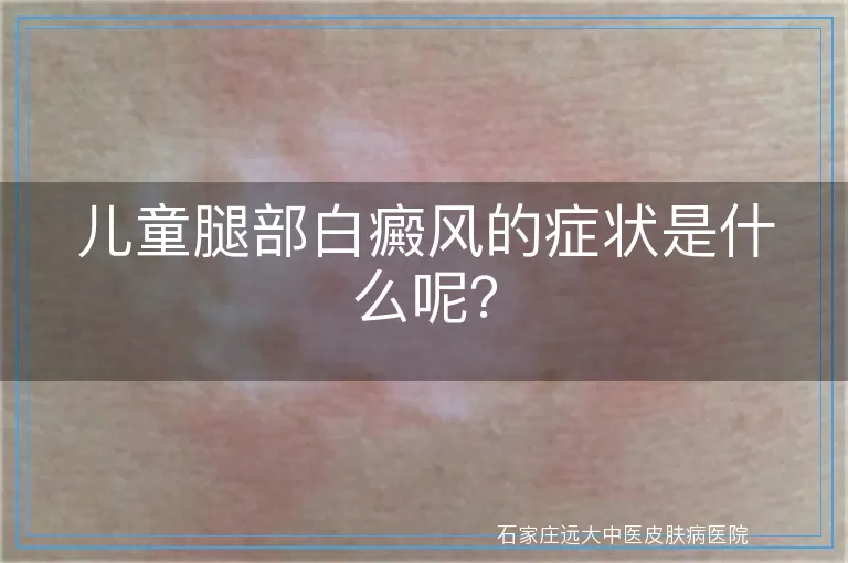 儿童腿部白癜风的症状是什么呢？