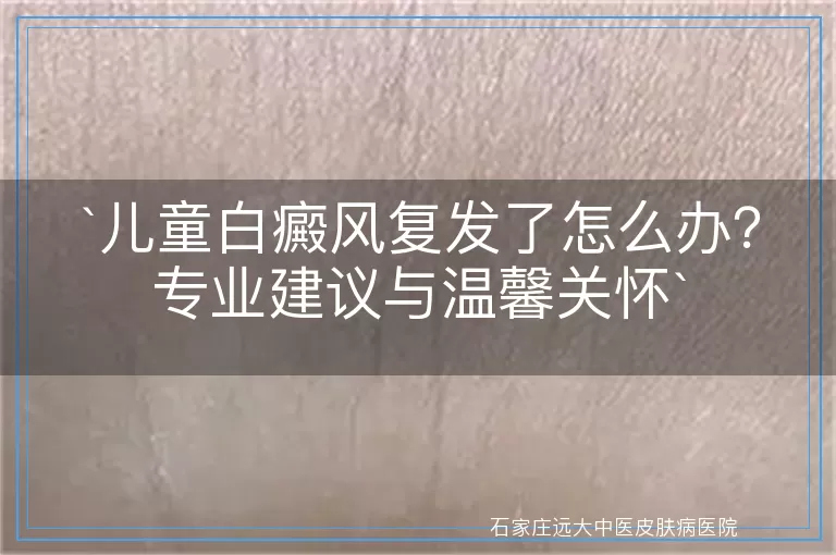 儿童白癜风复发了怎么办？专业建议与温馨关怀
