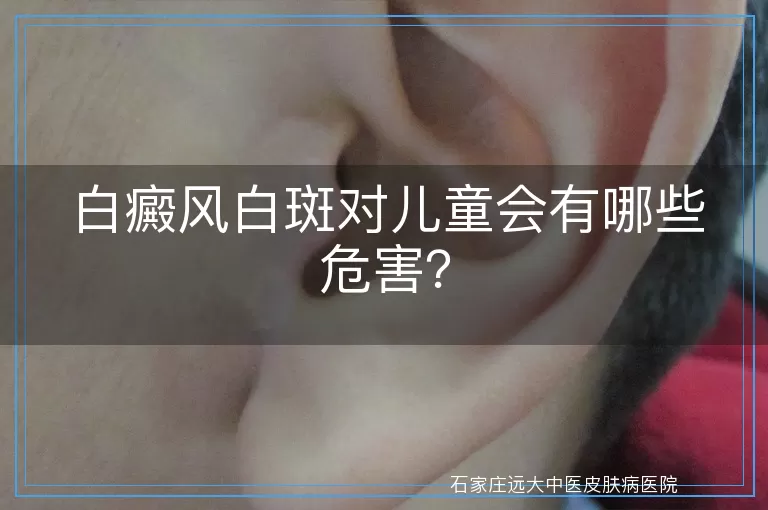 白癜风白斑对儿童会有哪些危害？